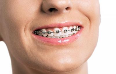 Il dentista spiega : apparecchio denti,  quanti tipi esistono?  