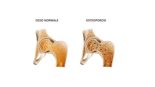 Giornata Mondiale dell’Osteoporosi, incontri e screening nelle Marche