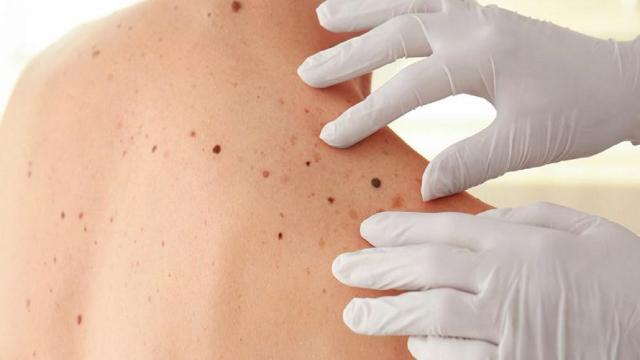 L'importanza della mappatura dei nei per la prevenzione precoce del melanoma