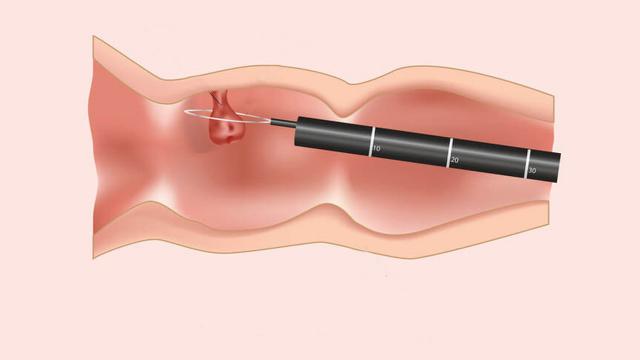 La Regione Marche estende screening tumore del colon-retto alla fascia di età 70-74 anni 