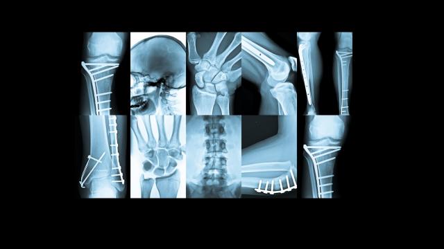 Area Vasta 5, al ''Mazzoni'' di Ascoli Piceno attivata Sezione di Radiologia d'Urgenza