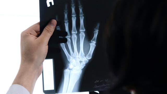 Ast Ascoli: Giornata Mondiale osteoporosi, porte aperte negli ospedali ‘Mazzoni’ e ‘Madonna del Soccorso’