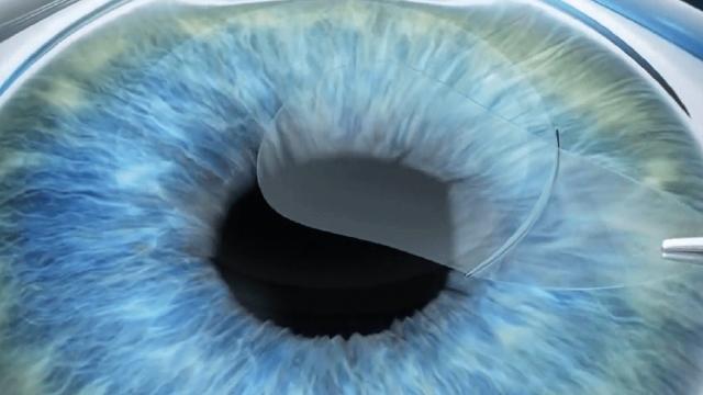 Chirurgia refrattiva con laser PRK: la risposta definitiva ai difetti della vista