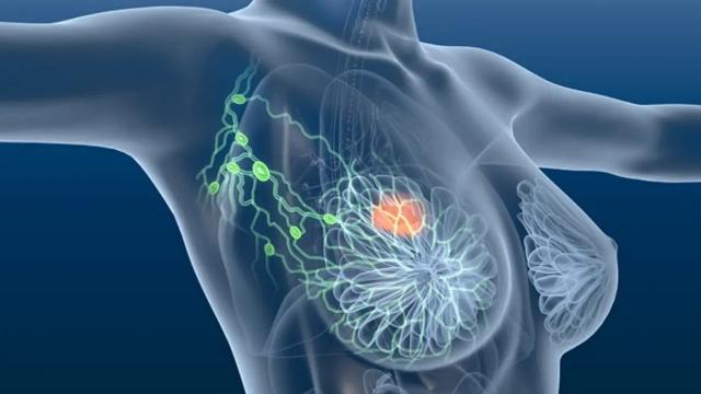 Screening tumore mammella nelle Marche, esteso anche alle donne di età compresa tra 45 e 49 anni e 70 e 74 anni