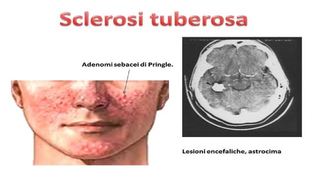 Monteprandone aderisce a tre giornate di sensibilizzazione sulla sclerosi tuberosa 