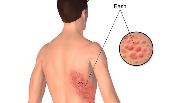 Federfarma Marche, 126 farmacie marchigiane pronte per campagna vaccinale e sensibilizzazione sull'herpes zoster