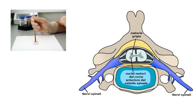 Atrofia Muscolare Spinale, al via nelle Marche lo screening neonatale